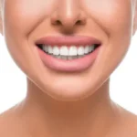 Can Teeth Be Straightened at Any Age, how much do braces cost​