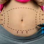 how much does a tummy tuck cost​