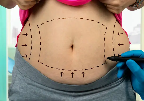 how much does a tummy tuck cost​