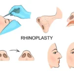how much is a nose job